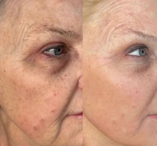 Comparație înainte și după bio-microneedling pentru uniformizarea aspectului tenului