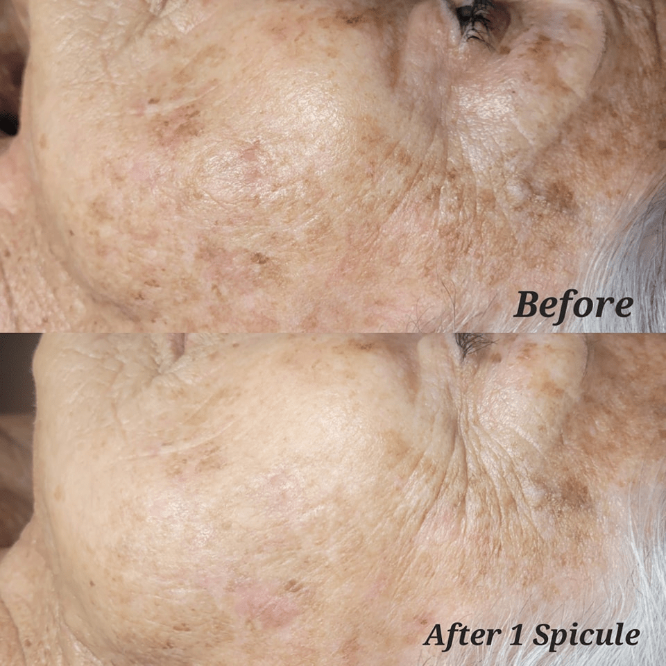 Comparație înainte și după bio-microneedling pentru aspectul petelor pigmentare