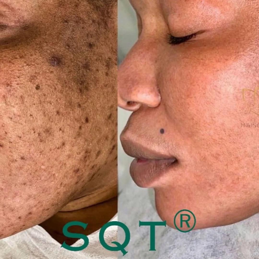 Rezultat bio-microneedling pentru textura și aspectul pigmentării pielii