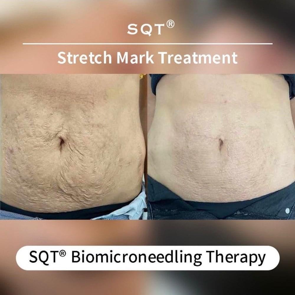 Comparație înainte și după bio-microneedling pentru aspectul vergeturilor