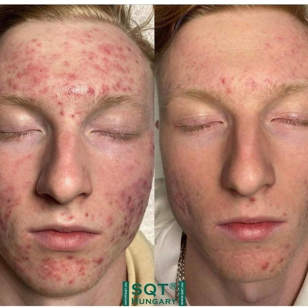 Comparație înainte și după bio-microneedling pentru un ten cu tendință acneică